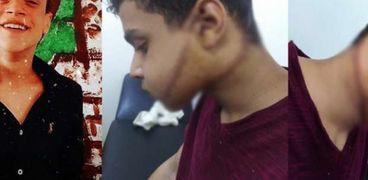 إصابة إيهاب حامد طالب الإعدادية المصاب بـ50 غرزة بالدقهلية