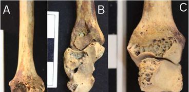 اكتشاف مومياء لأقدم مريض بالتهاب المفاصل الروماتويدي
