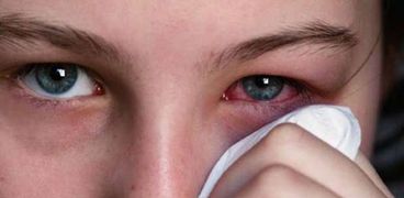 3 أعراض جديدة لفيروس كورونا: تصيب العين