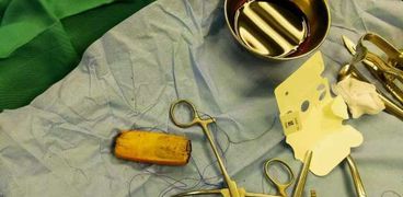 استخراج «هاتف محمول» من معدة مريض في مستشفى أسوان الجامعي