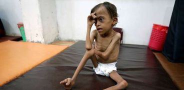 طفل يعاني من سوء التغذية