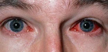 التهاب ملتحمة العين - أرشيفية