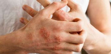 أمراض جلدية شائعة في فصل الشتاء