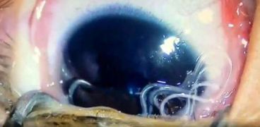 استخراج 11 نوع من الديدان من عين طفل صيني