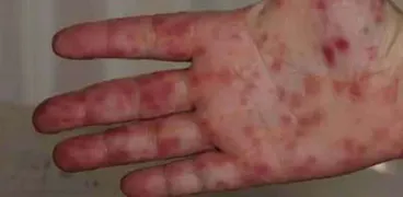 طفح جلدي أحمر لطفل مصاب بإنفلونزا الطماطم