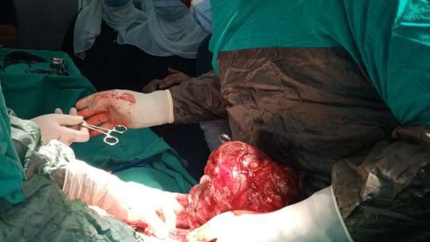 صورة استئصال ورم ضخم بالتجويف الأنفى لمريض بمستشفى قنا الجامعي – المحافظات