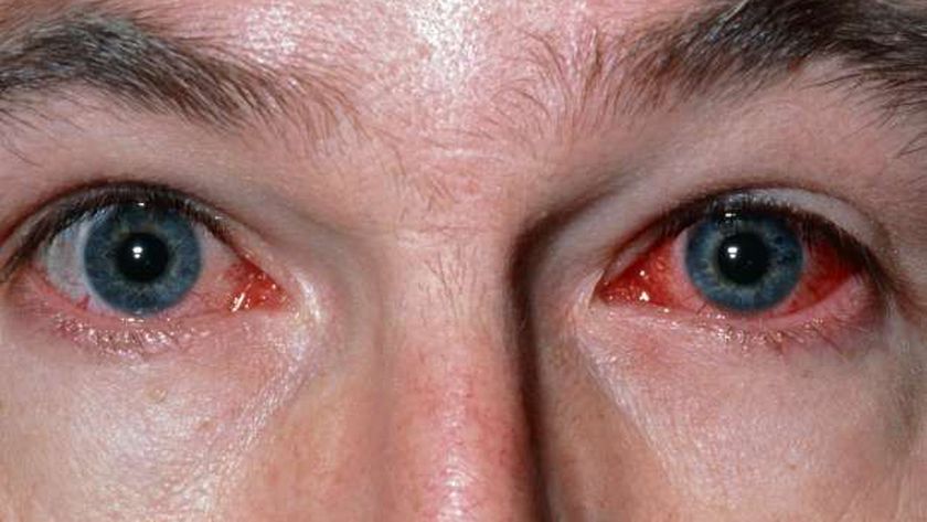 العين التهاب ملتحمة التهاب الملتحمة