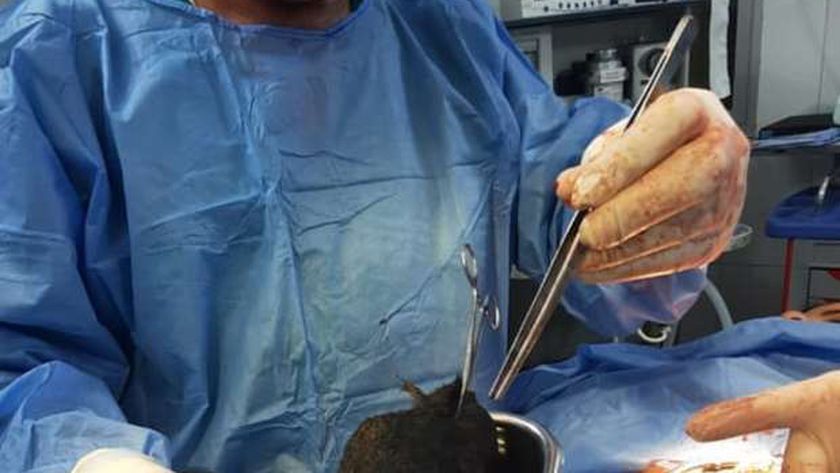 الدكتور طارق الكاسح خلال إستخراج كتلة شعر من بطن شاب  وزنت ثلاث كيلوجرامات
